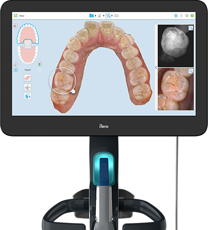 itero-scanner-thumb1 Shawbirch Dental
